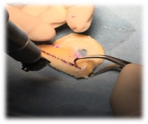 Mensical Graft Preparation